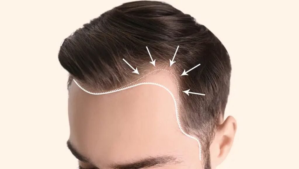 Hair Transplant